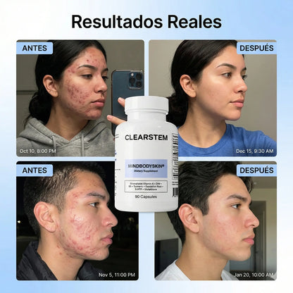 MINDBODYSKIN Clearstem - Acaba con el Acné Hormonal en 7 Días.