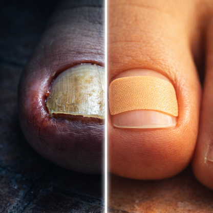 Parches Fungi Clinic, Devuelve la Salud a tus Uñas — Sin Dolor, Sin Cirugía, Sin Esperar Meses