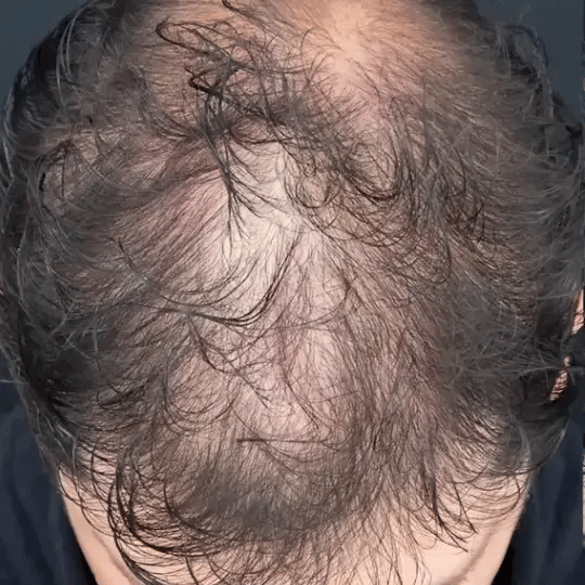 Fórmula Capilar DHT Blocker™ | Apoya el Crecimiento y Fortalece tu Cabello 👨‍⚕️
